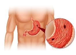 Durere abdominala, durere testicol, picior amortit. Dureri De Coaste De Pe Spate Hondrocream