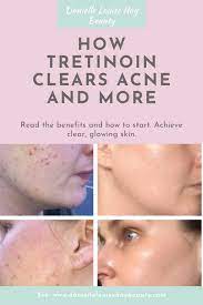 Maybe you would like to learn more about one of these? How To Use Tretinoin Retin A The Benefits And Side Effects The Products To Use And Avoid Whilst Using Tretinoin Tretinoin Tretinoin Acne Tretinoin Routine