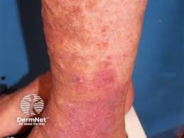 Image result for Stasis Dermatitis