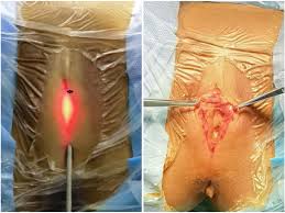 Image result for Labial Fusion