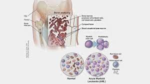 Leukemia, also spelled leukaemia, is a group of blood cancers that usually begin in the bone marrow and result in high numbers of abnormal blood cells. What Is Acute Myeloid Leukemia Aml Cancer Refractory And Relapsed Prognosis Symptoms Treatment And More Everyday Health