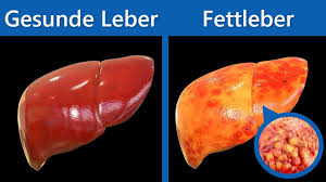 Diese Lebensmittel Musst Du Essen Um Einer Fettleber Vorzubeugen Oder Um Sie Zu Heilen Youtube