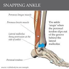 The medial retinaculum is located within the knee joint; Snapping Ankle Or Clicking Ankle Core Concepts Physiotherapy