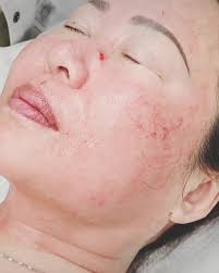 🌟 Join Us at AMWC Bangkok! 🌟⁠ Visit the #1 Microneedling Company