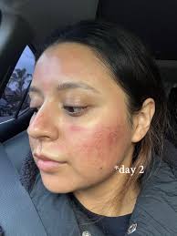This is after just 1 treatment! I will be doing a total of 3 treatment...