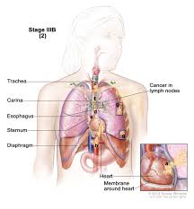 Colorectal cancer almost always develops from precancerous polyps (abnormal growths) in the colon or rectum. Non Small Cell Lung Cancer Treatment Mhealth Org