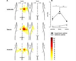 Body Chart A Showing Superimposed Pain Distributions After