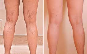 Microsclerotherapy Vein Treatment Renew Medical Aesthetics Cheshire