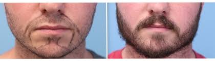 Beard hair transplant to head. Beard Hair Transplant Parsa Mohebi Hair Restoration Parsa Mohebi Hair Restoration
