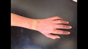 Most burns heal without becoming infected. First Degree Burn Youtube