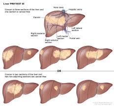 The likelihood of surviving a diagnosis of childhood cancer depends on the country in which the child lives: Herenciageneticayenfermedad Childhood Liver Cancer Treatment Pdq 1 3 Health Professional Version National Cancer Institute