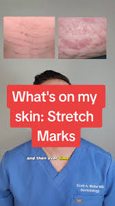 Understanding Stretch Marks and Effective Treatment by a Dermatologist
