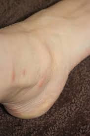 Bug Bites That Look Like Mosquito Bites But Aren T Home Remedies For Horrible Bug Bites 1 Put An Ice Pack On The Bites 2 Grind Aspirin To Powder Bug Bites Remedies Remedies For Mosquito Bites Home Remedies