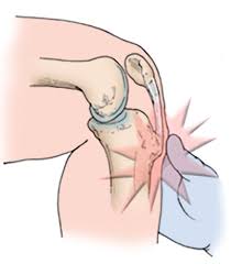 Osgood Schlatter Disease Knee Pain Orthoinfo Aaos