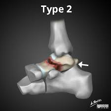 Image result for Talus Fracture