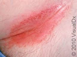 Image result for heat rash under breasts
