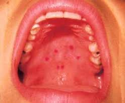 If you have had this bump for more than one week, you really should have it checked out. Pain On Roof Of Mouth Hurts Bump Sore Lump Red Spots Swelling Ridges At Back Of Mouth