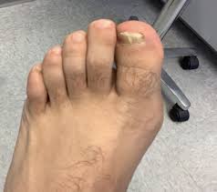 Image result for brown patches on the feet