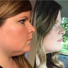 Fat Friends Turn On Newly Fit Woman As She Drops Nine Stone After A  Lifetime Of Being Obese