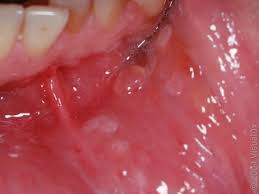 Image result for Hand foot and mouth disease HFMD roof of mouth