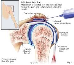 Image result for Subacromial Space Injection