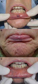Cherry angioma symptoms the condition is characterized by the development of lesions or growths on the skin surface. Treatment Of Lip Hemangioma Using Forced Dehydration With Induced Photocoagulation Via Diode Laser Report Of Three Cases Oral Surgery Oral Medicine Oral Pathology And Oral Radiology