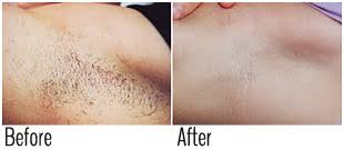 Laser hair removal for blonde hair: Best Laser Hair Removal Nyc Laser Hair Removal Brooklyn