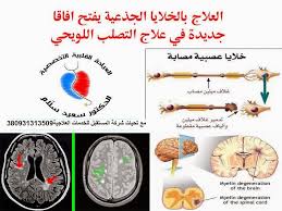 التصلب المتعدد ويعرف بأسماء عديدة، منها التصلّب اللويحي والتصلب المنتثر أو التهاب الدماغ والنخاع المنتثر (بالإنجليزية: Ù…Ø§ Ù‡Ùˆ Ø§Ù„ØªØµÙ„Ø¨ Ø§Ù„Ù„ÙˆÙŠØ­ÙŠ