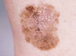 You might be born wi. Dermoscopy As A Technique For The Early Identification Of Foot Melanoma Journal Of Foot And Ankle Research Full Text