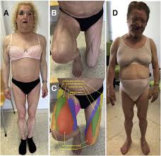 Image result for Lipodystrophy