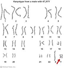 Xyy Syndrome Wikipedia