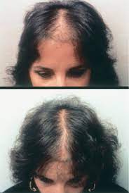 Causes of hair loss in female teenagers. Androgenetic Alopecia In Women Sciencedirect