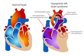 How To Spot Someone With Hlhs Congenital Heart Defect Heart Defect Congenital Heart