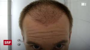 lifestyle die glatze mit eigenen haaren fullen puls srf