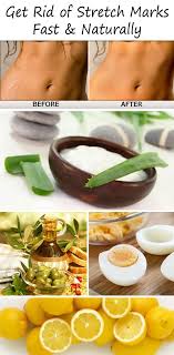 How To Get Rid Of Stretch Marks Fast Top 10 Home Remedies Beauty Remedies Stretch Marks Beauty Care