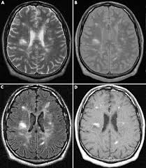 In these images, the contrast and brightness are predominately determined by the t2 properties of tissue. Imaging In Multiple Sclerosis Journal Of Neurology Neurosurgery Psychiatry