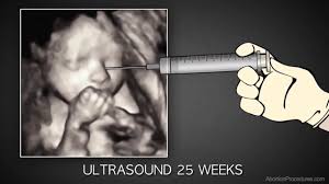 If you are wondering how to abort 3 weeks pregnant up to about the 7 th week, one option is to use abortion medications. Methods Of Abortion Pregnancy Services