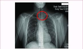 Image result for SC Dislocation