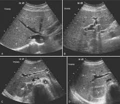 Ultrasound Of The Liver Biliary Tract And Pancreas Ultrasound Ultrasound Sonography Medical Ultrasound