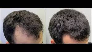 Using aloe vera gel is one among the easy and effective remedies that can help to. How Can One Increase The Density Of Hair On His Head Quora