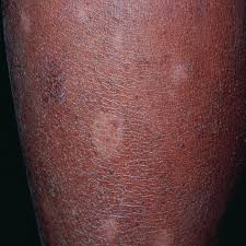 Image result for Postinflammatory Hypopigmentation