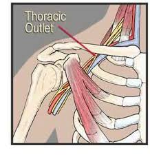 Research Based Massage For Thoracic Outlet Syndrome Thoracic Massage Marketing Massage Pictures