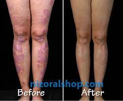 For severe or recurring cases of vaginal yeast infections, a doctor may prescribe oral medication, vaginal cream, or a strong suppository. Ketoconazole Cream 2 Used For Acne