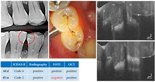 We therefore investigated the physical and microstructural properties of carious dentin in the 4 different zones to determine important differences revealed by caries. Jcm Free Full Text An Intraoral Oct Probe To Enhanced Detection Of Approximal Carious Lesions And Assessment Of Restorations Html