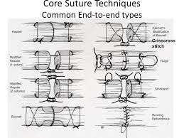 We reviewed the literature regarding the choice of suture material and repair technique. Flexor Tendon Injuries Ppt Download