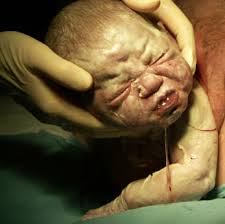 Wound break down (dehiscence) smelly vaginal discharge. Episiotomy Vaginal Tears Perineal Massage Complications Stitches