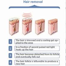 Some prescription oral medications have been clinically observed to slow. Shr Permanent Hair Reduction Treatments Vie Aesthetics