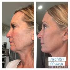 Let's clear this up — Sculptra is not filler! Yes, it will give subtle  volume SLOWLY over time… which is why we love it btw … 🙌 But It stimulates  your body