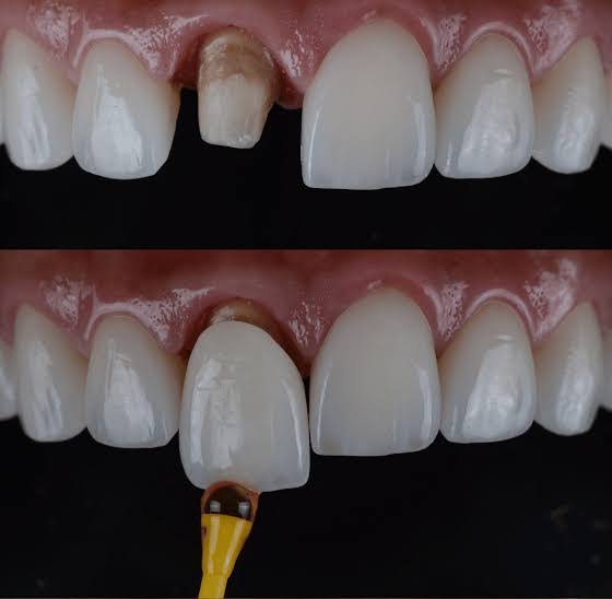 Dental crown product image