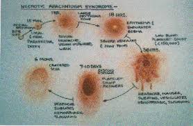 Necrotic Arachnidism Syndrome Badspiderbites Com